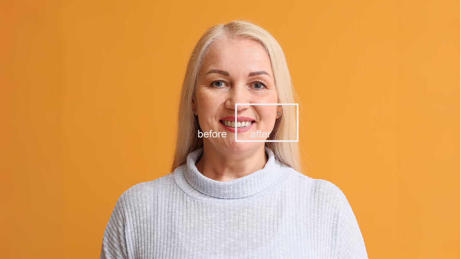 Veneers or Dentures: Which Should You Choose?