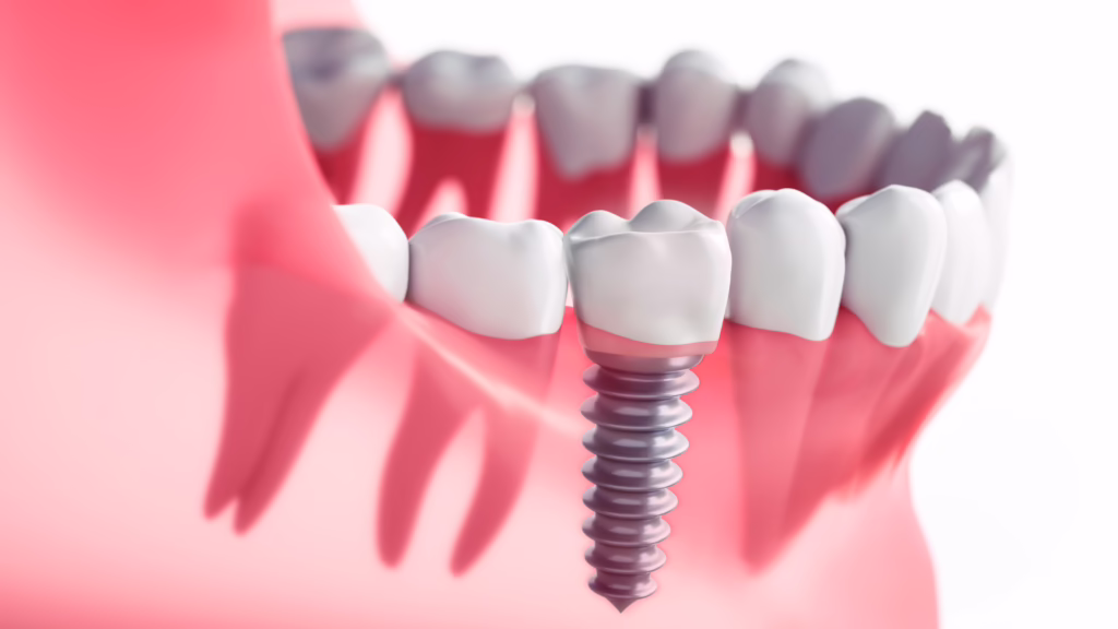 The Many Benefits of All-on-4 Dental Implants